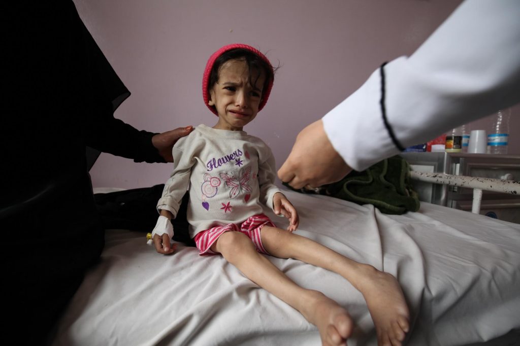 severely malnourished child crying and sitting on a hospital bed