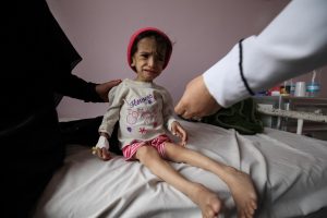 severely malnourished child is sitting on a hospital bed