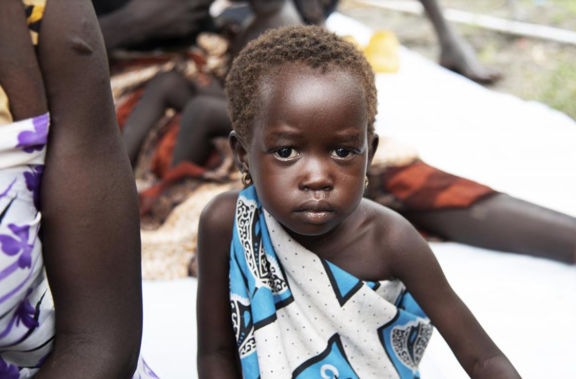 young girl suffering from malnutrition is fixing the camera