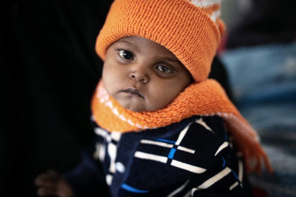 A baby in Yemen sufferes damage to eyesight from malnutrition 