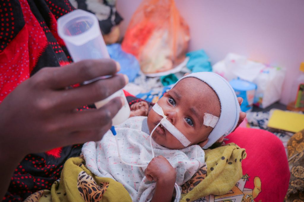 malnourished child being fed