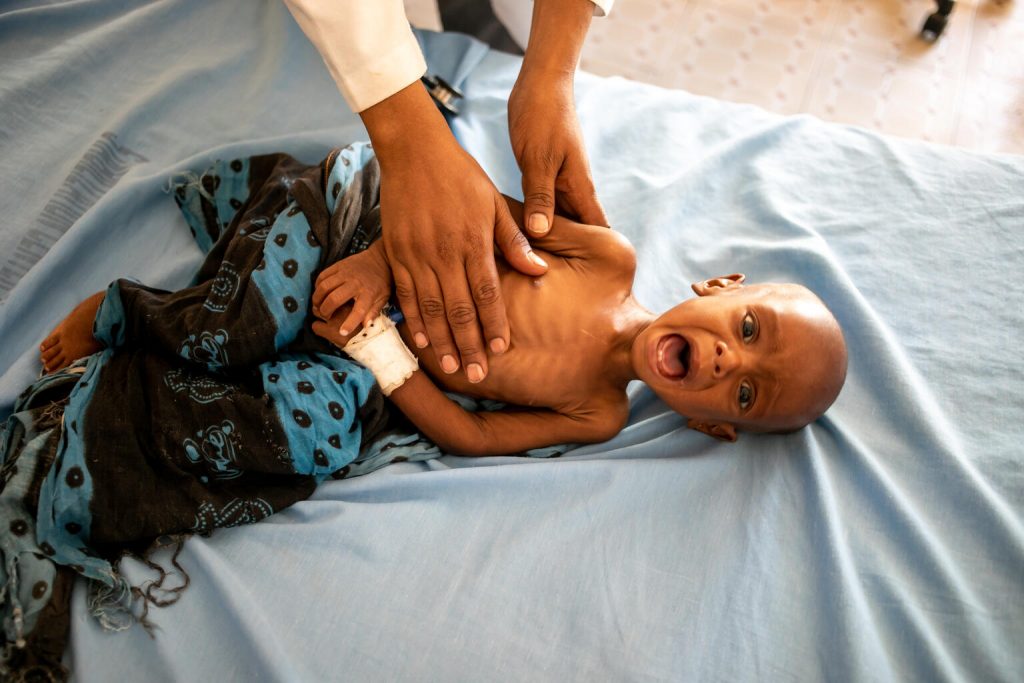 malnourished child crying