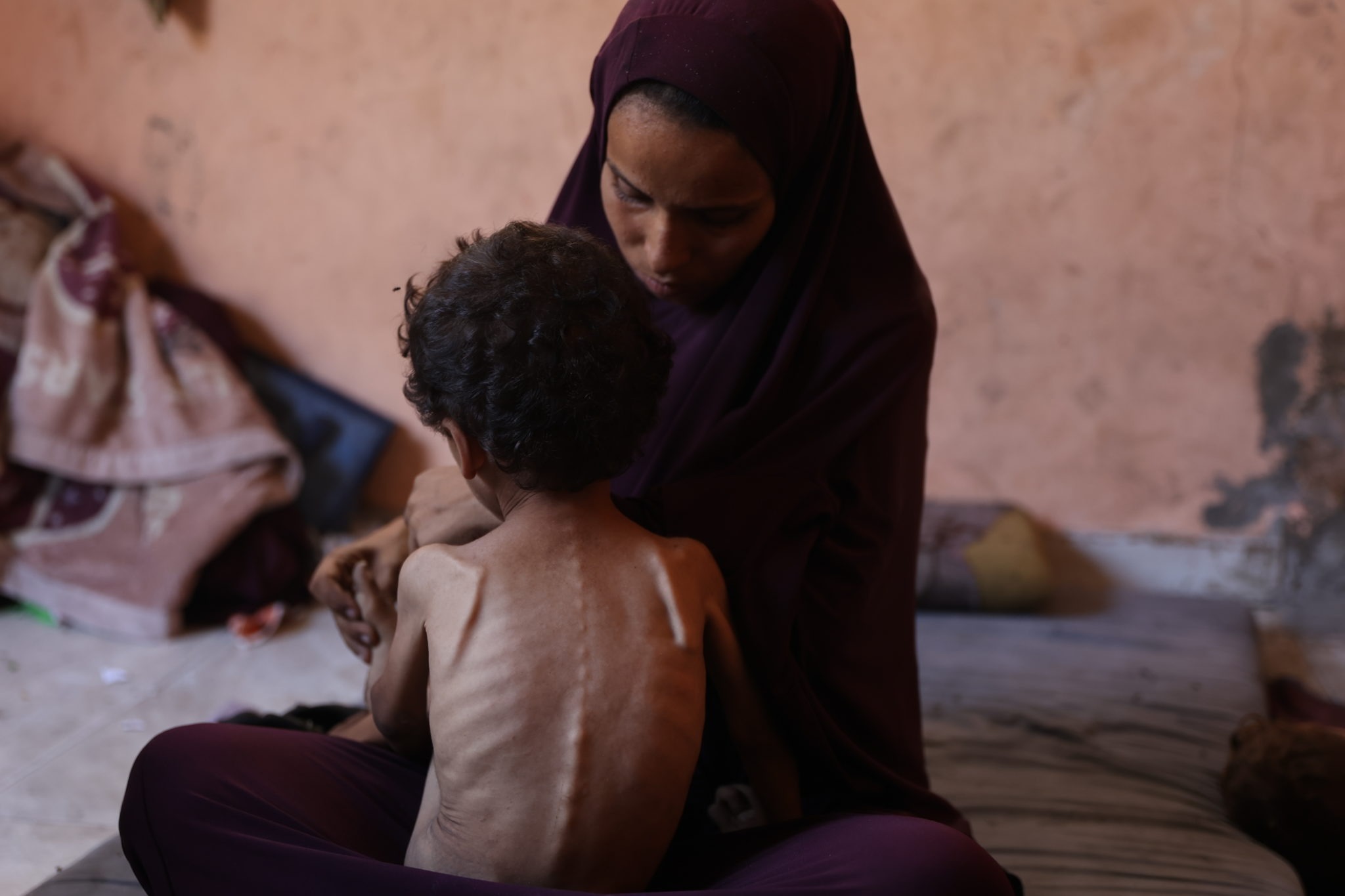 2 year old Yazan is just skin and bone in Gaza. He needs help now.