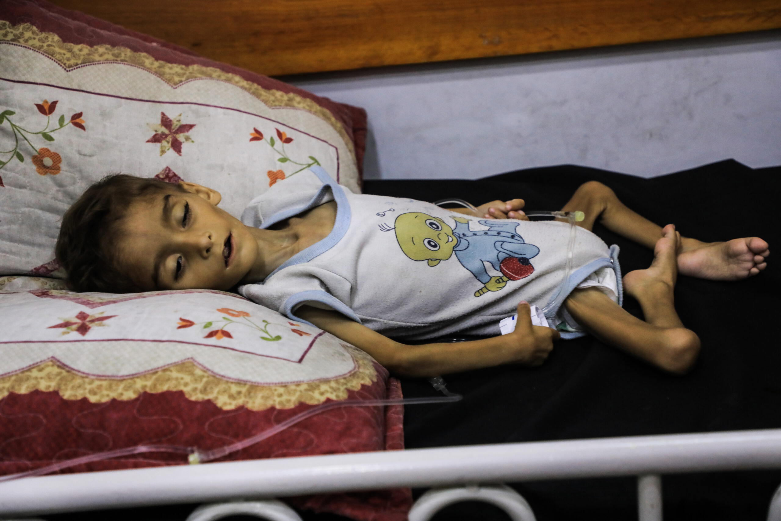 A child suffering from malnutrition lies on a bed in a hospital in Gaza, donate and help send life-saving aid to children in need.